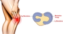 Dış Menisküs Belirtileri ve Tedavisi