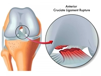 Menisküs Ameliyatı Riskleri ve Sonrası