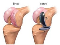 Yapay Menisküs Belirtileri ve Tedavisi