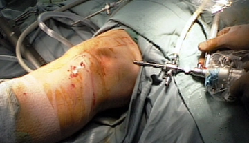 Artroskopi Nedir? ve Nasıl Yapılır